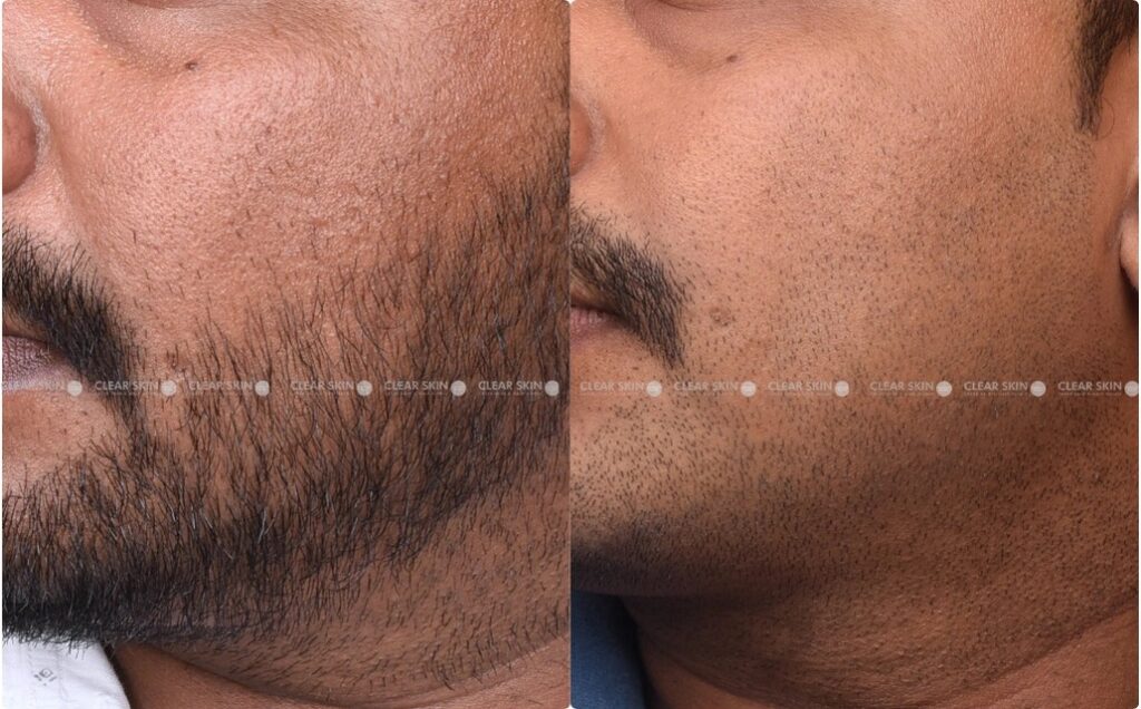 How Laser Carbon Peel Rejuvenates Dull and Tired Skin