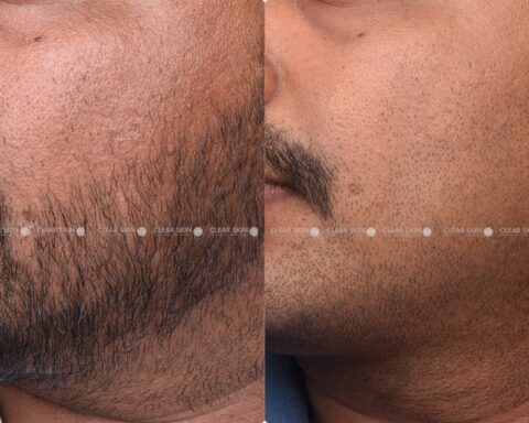 How Laser Carbon Peel Rejuvenates Dull and Tired Skin