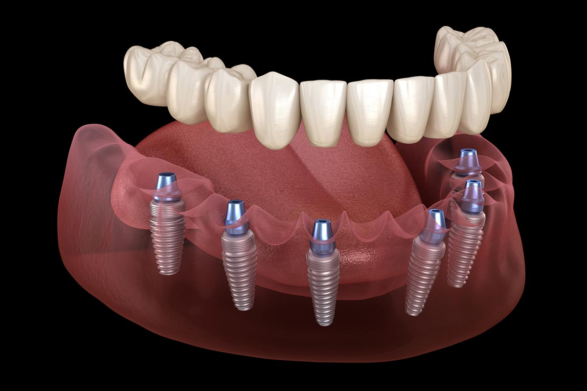 Dental