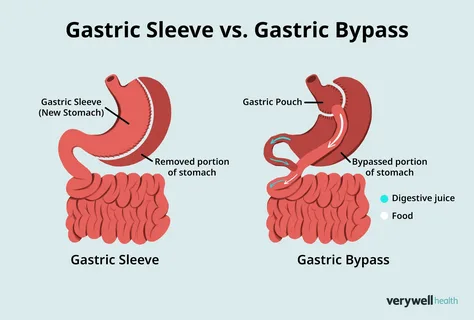 Is Gastric Sleeve Right for You
