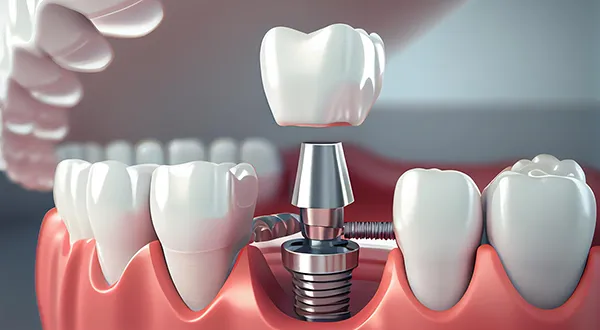 How Modern Dental Technology Is Making Tooth Replacement More Accessible