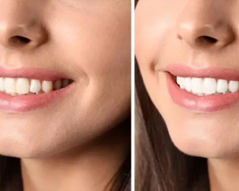 Smile Makeovers in the Digital Age How Modern Dentistry Is Changing Patient Confidence