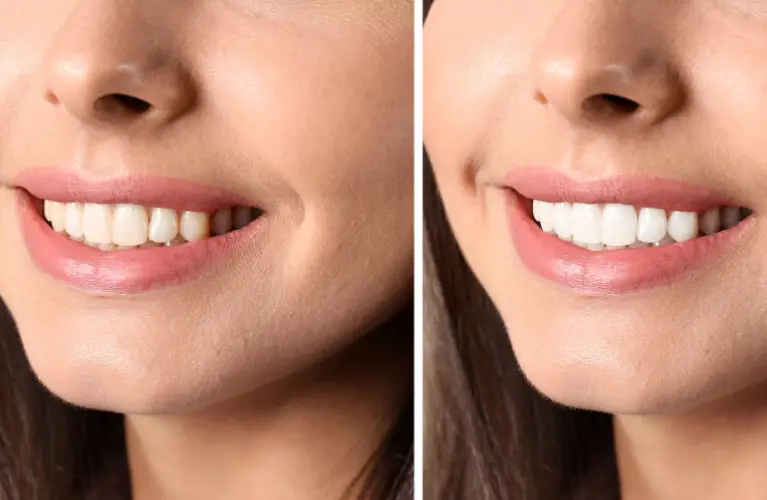 Smile Makeovers in the Digital Age How Modern Dentistry Is Changing Patient Confidence